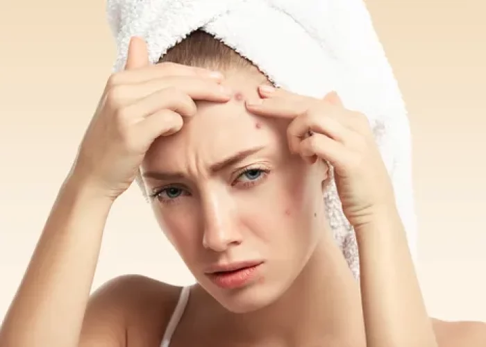 Woman with pimples_How to Get Rid of Pimples Fast